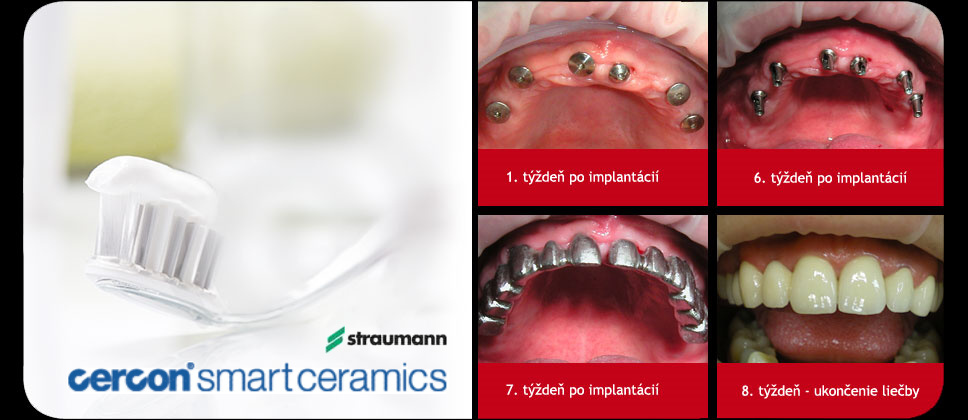CS2implantaty-vsetky zuby.jpg